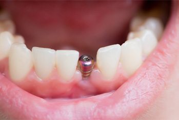 closeup of dental implant in Temple