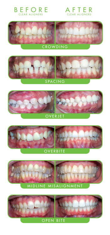 Before and after clear correct patient smiles