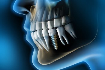 X-ray of a person with a dental implant 