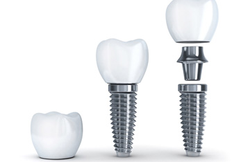dental implant crown, post, and abutment  