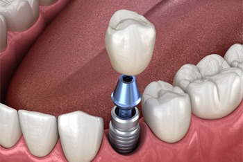 single dental implant with a crown