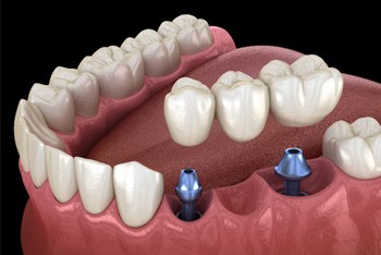 two dental implants with a dental bridge on top
