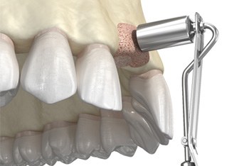 dental bone graft in the upper arch 