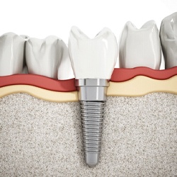 3D illustration of a dental implant