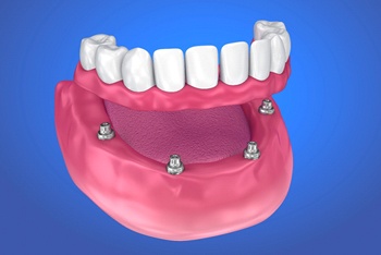 Diagram of an implant denture in Temple