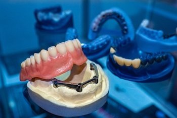 Implant denture in Temple during the fabrication process