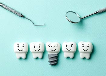 Illustration of dental implant in Temple