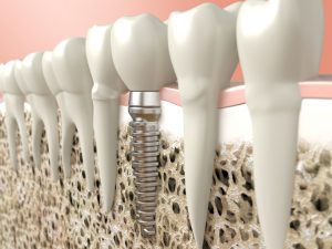 Discover the cost of dental implants in Temple.