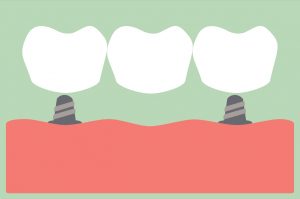 Dental implants in Temple anchor your dental prosthetics permanently. 