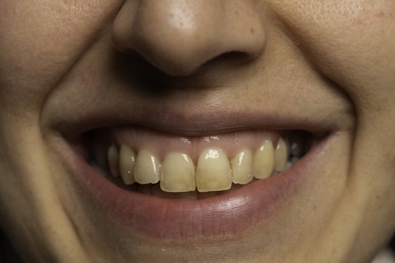 Woman with stained teeth